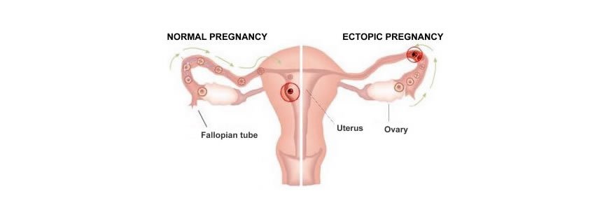 Dış Gebelik (Ektopik Gebelik)