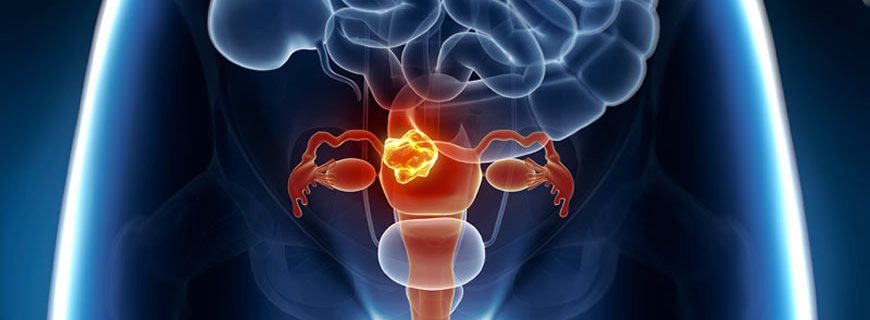 Rahim Kanserinin Belirtiler Nelerdir?