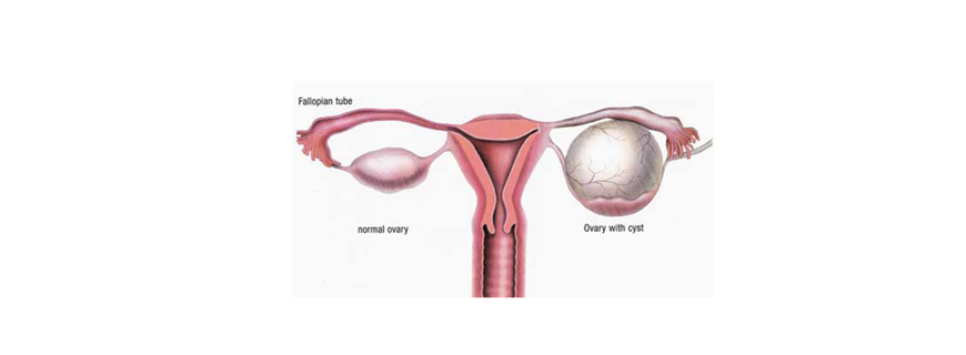 Endometrioma - Yumurtalık Kisti